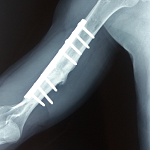 Faut-il bannir l’embrochage de Hackethal de la prise en charge ...