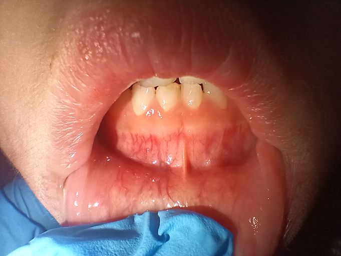 Gingival telangiectasias as an underrecognized sign of juvenile dermatomyositis