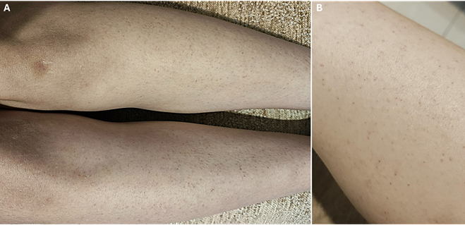 Cytomegalovirus-induced petechial rash in an immunocompetent patient with acute hepatitis