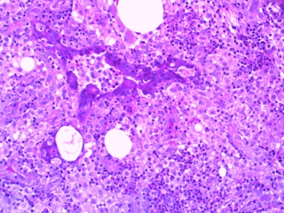 Idiopathic granulomatous mastitis: a diagnostic pitfall mimicking recurrent breast abscess